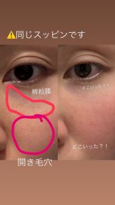 開き毛穴へ