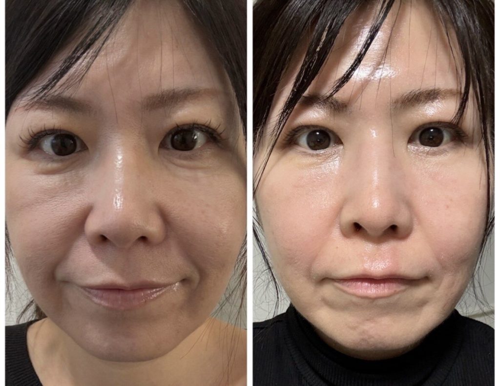 目の下のたるみ引き締め